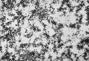 F,50y. | progressive multifocal leukoencephalopathy- viral particles in a glial cell F,50y. | progressive multifocal leukoencephalopathy- viral particles in a glial cell